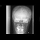 Multiple myeloma, lytic lesions: X-ray - Plain radiograph